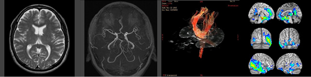 MRI検査による画像例
